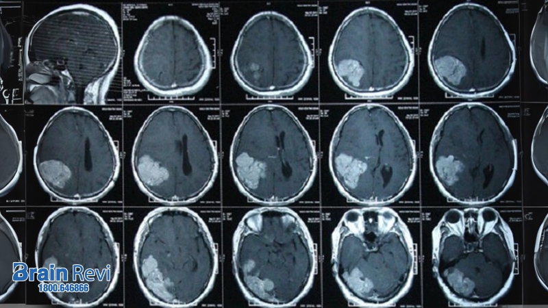 Chụp CT giúp việc chẩn đoán chảy máu trong não và một số tình huống bất thường khác