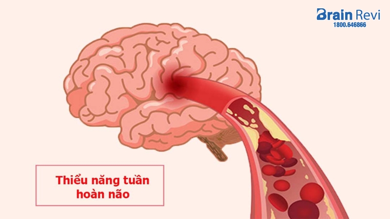 Thiểu năng tuần hoàn não là tình trạng lượng máu lên não giảm