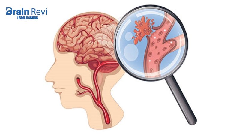 Đột quỵ là tình trạng não bị tổn thương nghiêm trọng do quá trình cấp máu cho não bị gián đoạn