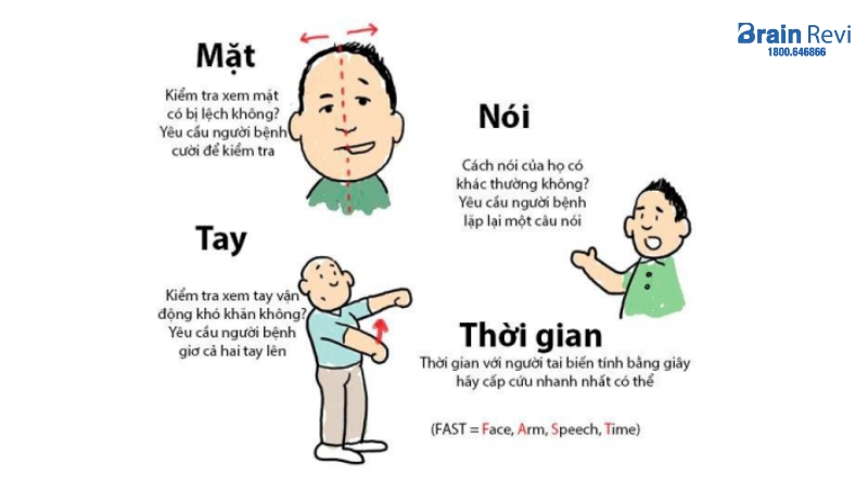 Dấu hiệu đột quỵ não